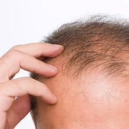 Hair Restoration Treatment