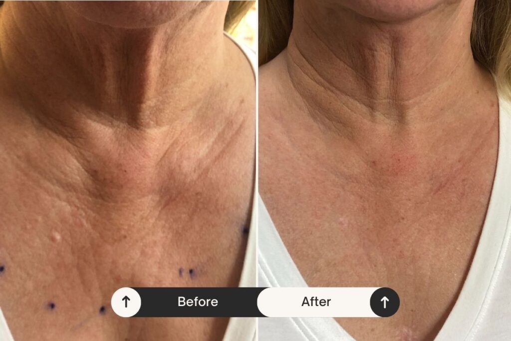 Collagen-stimulating injections before and after - london - Dr. Michael