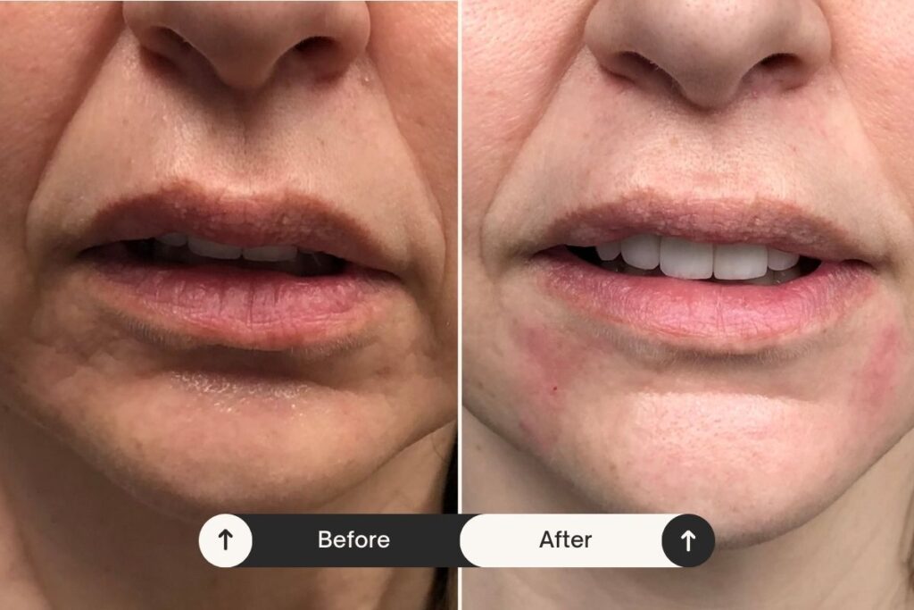 Dermal fillers before and after - london - Dr. Michael