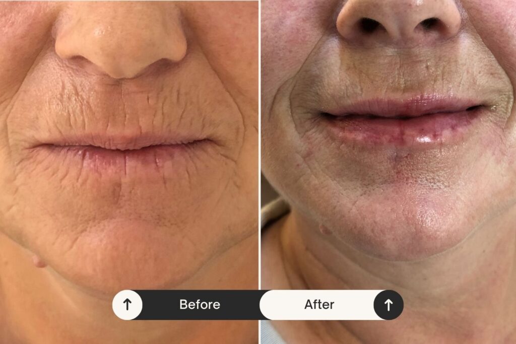 Skin booster treatment before and after
