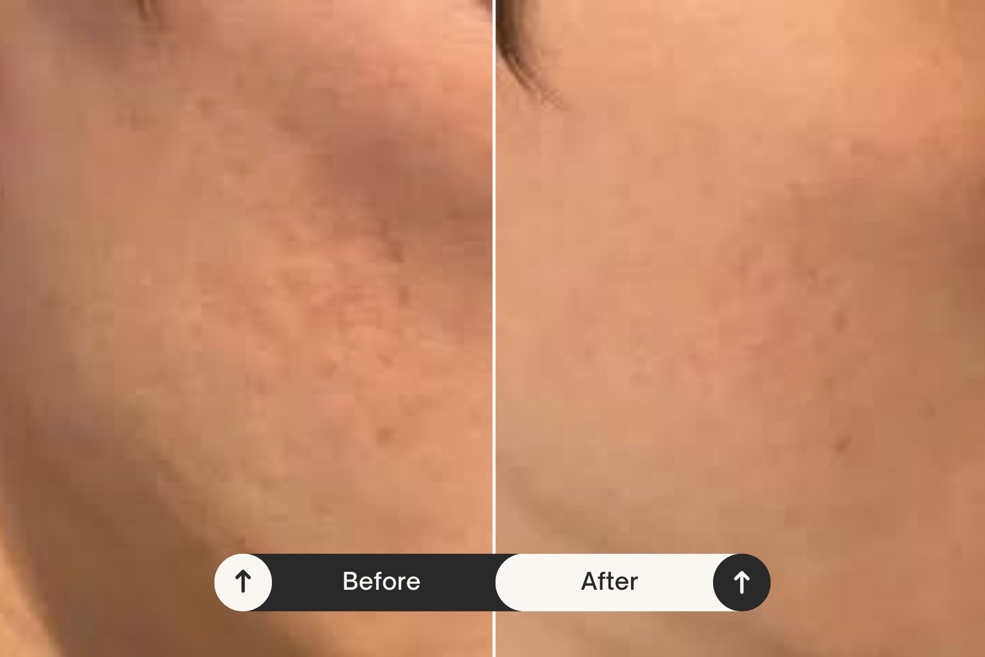 acne scarring before and after
