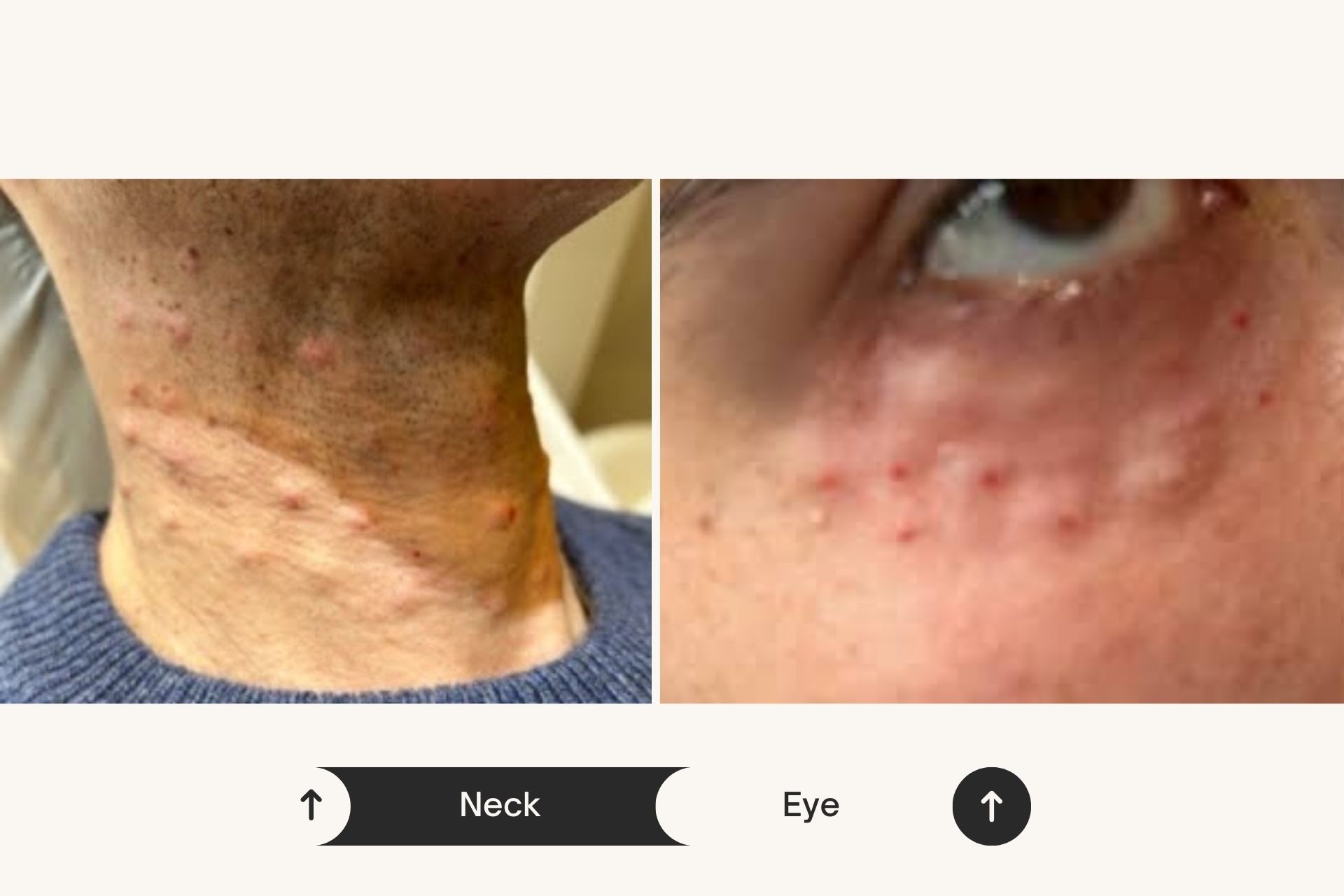 neck and eye immediately after polynucleotides treatment