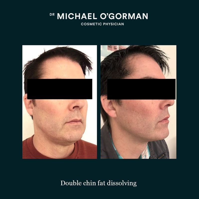 Fat Dissolving Injections before and after Dr Michael