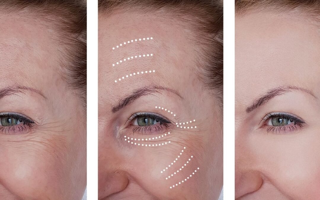 London Dermal Fillers Guide: Pricing, Tips, and FAQs